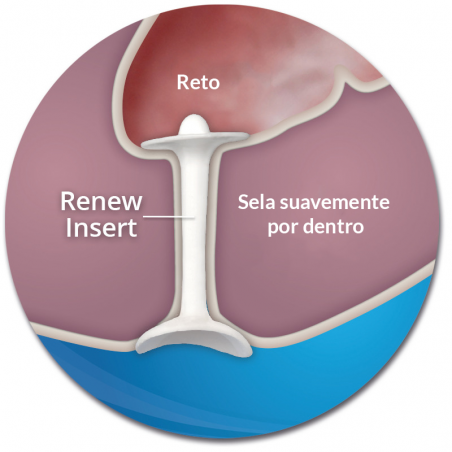 Renew Insert - Tampão Anal Renew